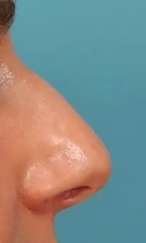 Rhinoplasty Case 4665: before