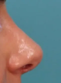 Rhinoplasty Case 4665: after