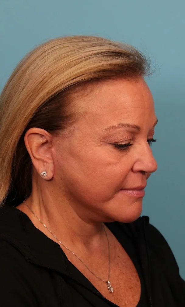 Facelift Before & After Patient #4655