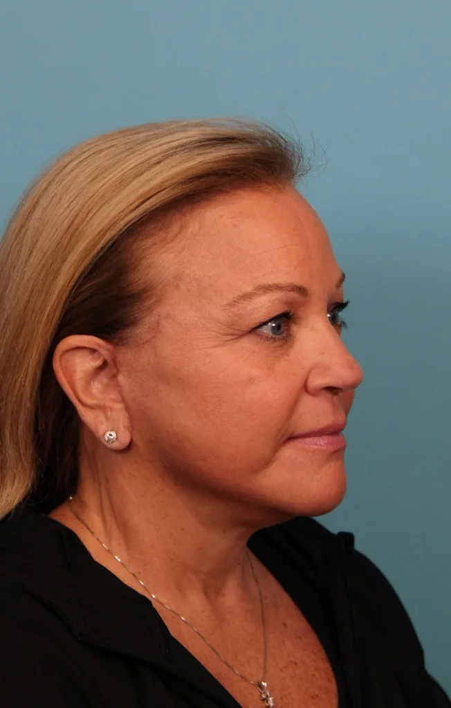 Facelift Before & After Patient #4655