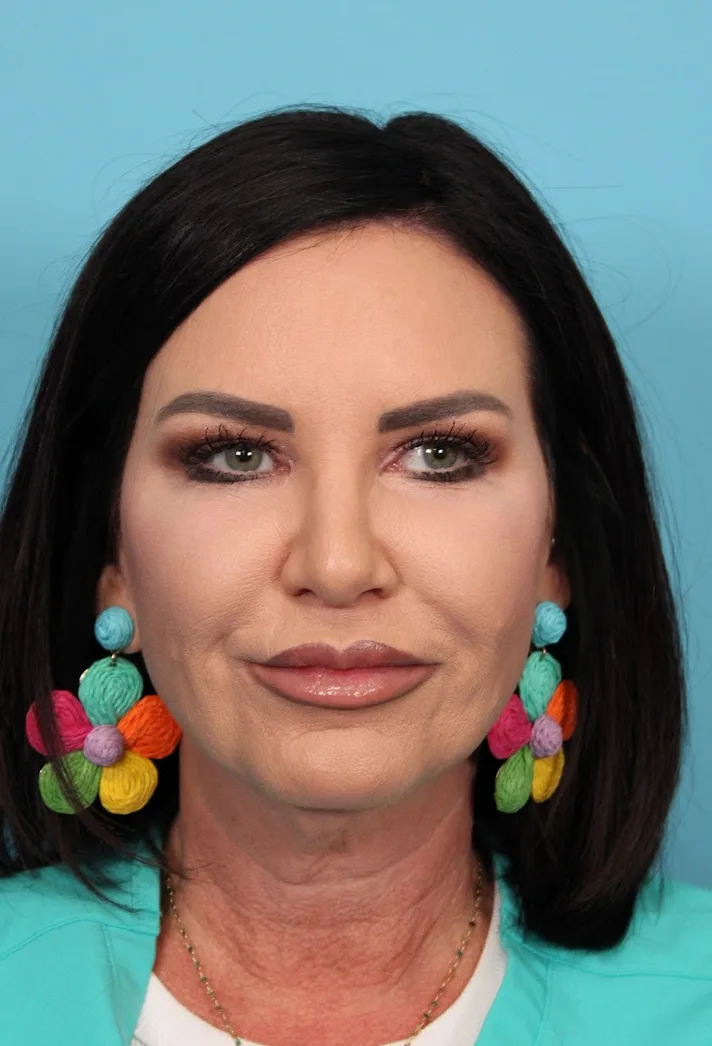 Facelift Before & After Patient #4656
