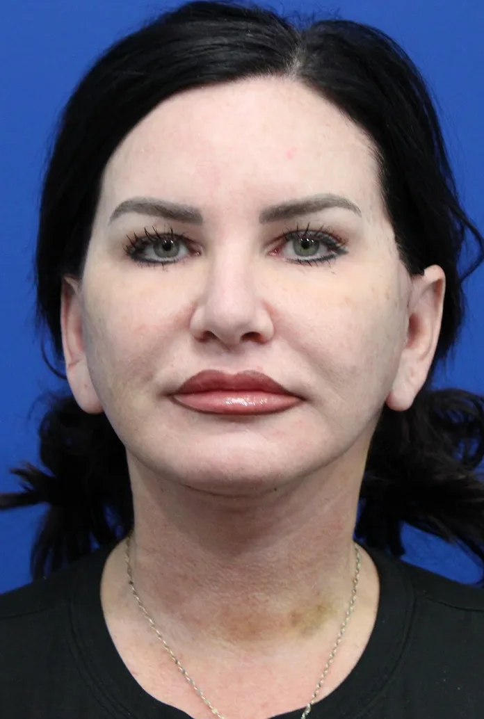 Facelift Before & After Patient #4656