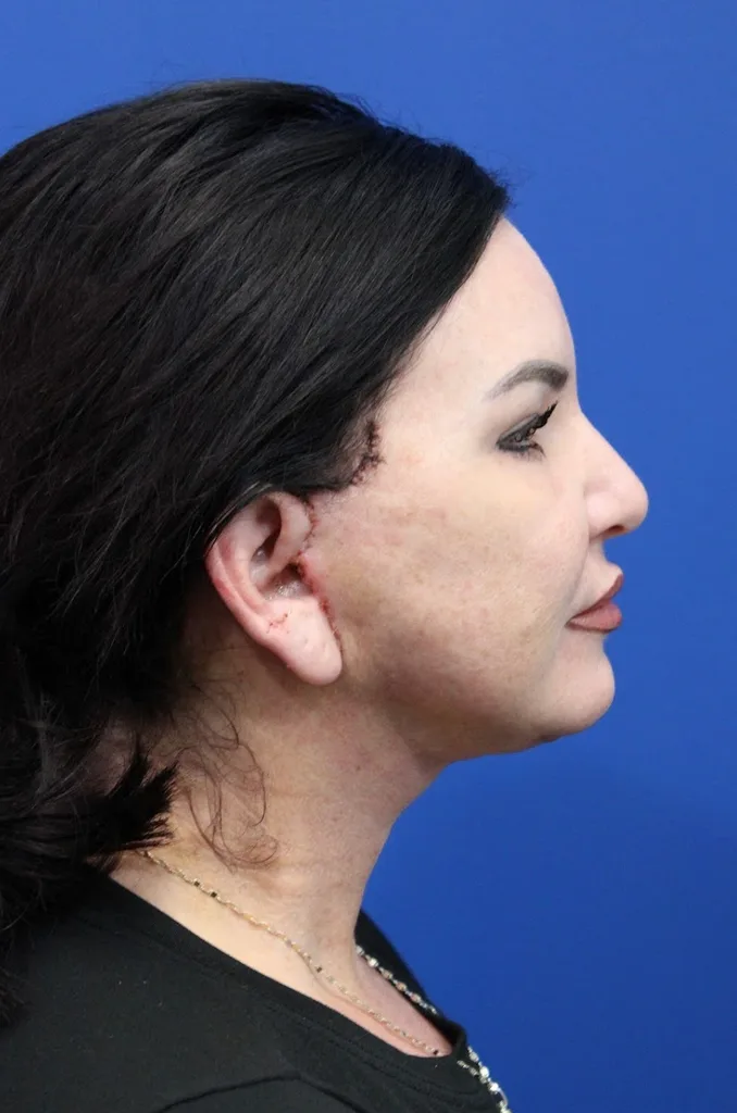 Facelift Before & After Patient #4656