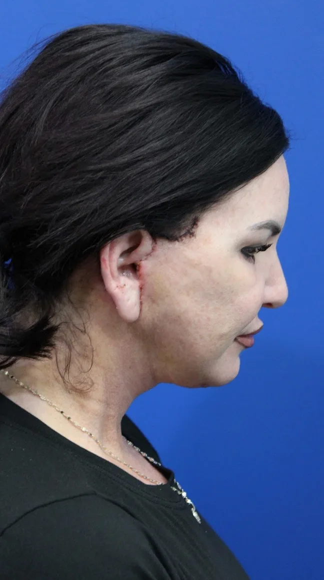 Facelift Before & After Patient #4656