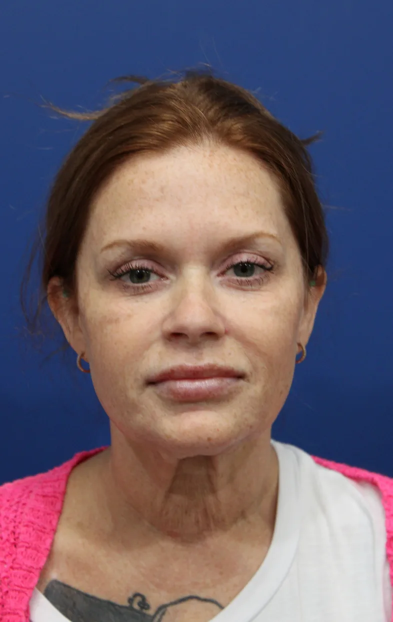Facelift Before & After Patient #4657