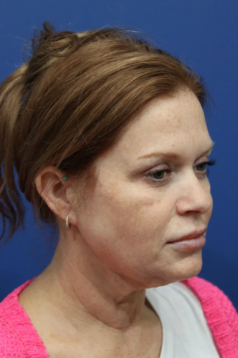 Facelift Before & After Patient #4657
