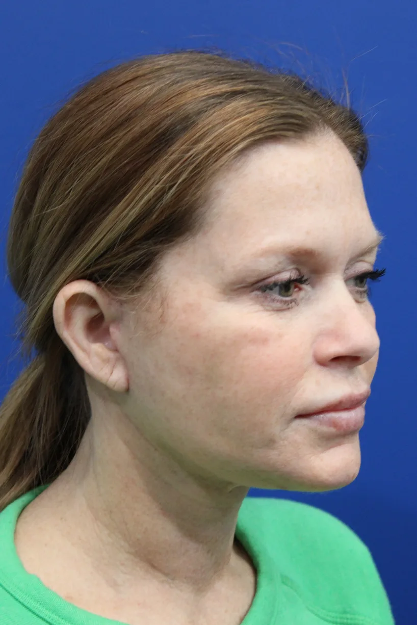 Facelift Before & After Patient #4657