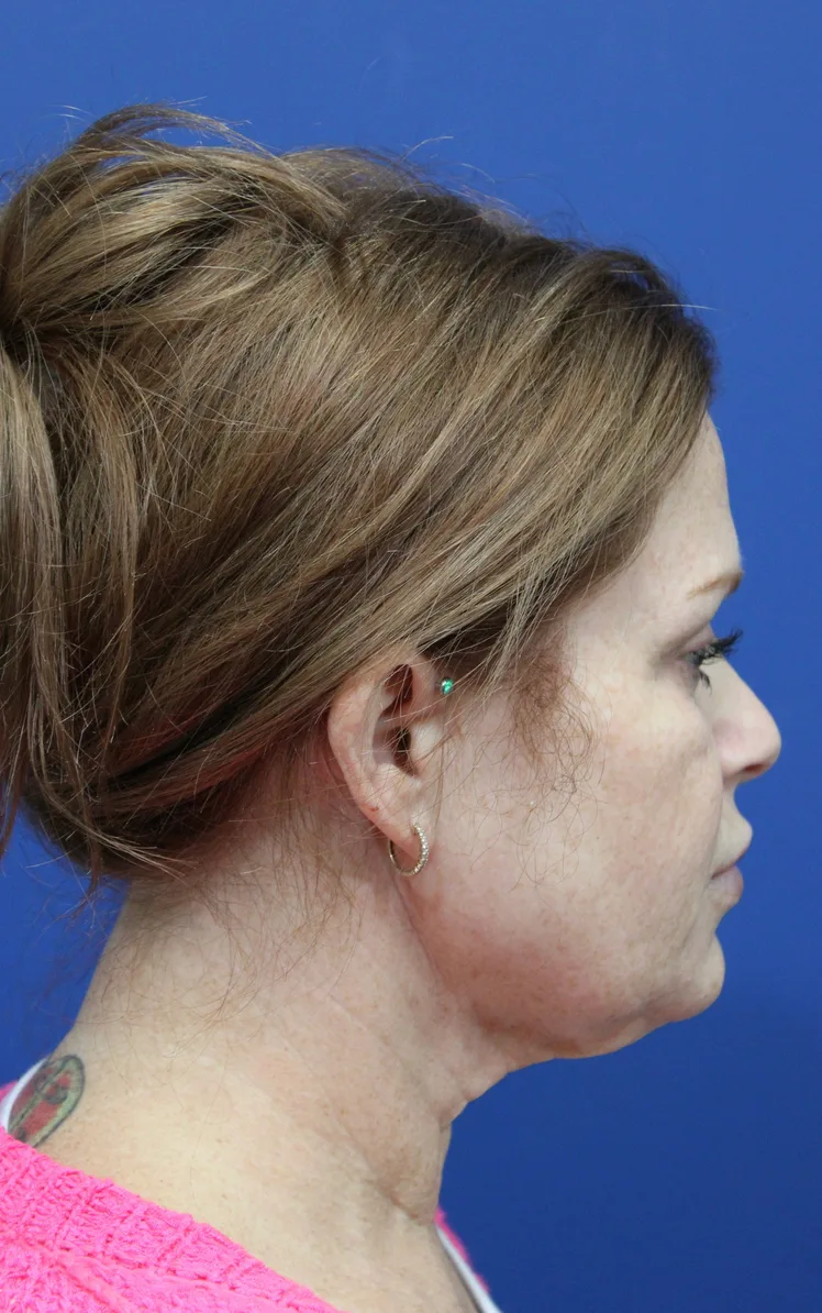 Facelift Before & After Patient #4657