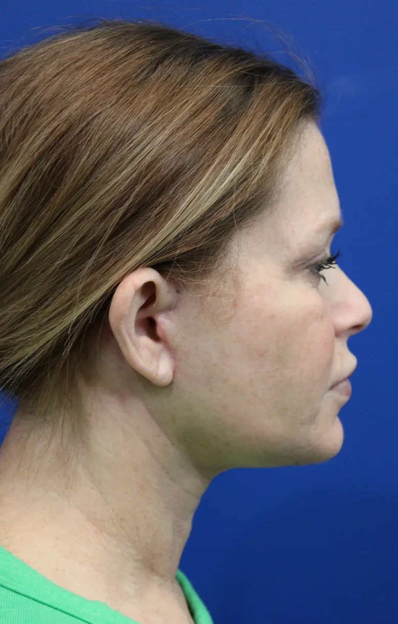 Facelift Before & After Patient #4657