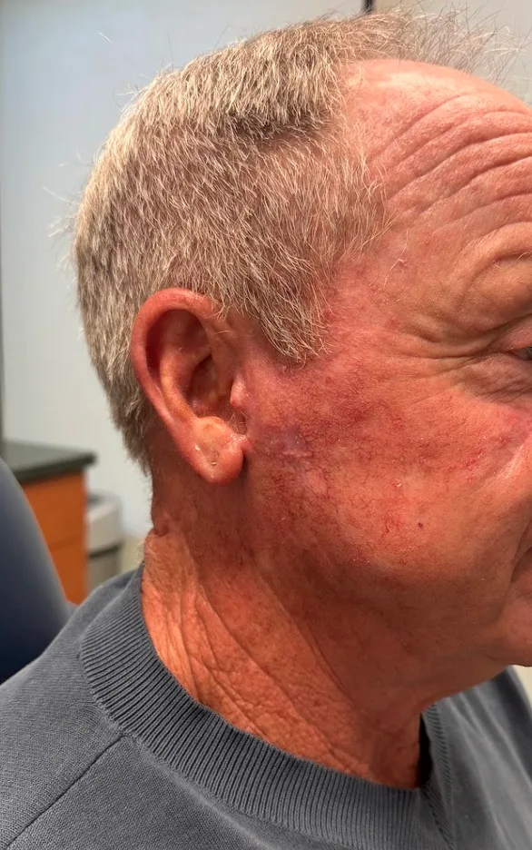 Mohs Surgery Before & After Patient #4659