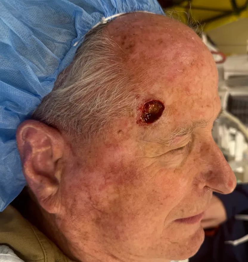 Mohs Surgery Before & After Patient #4660