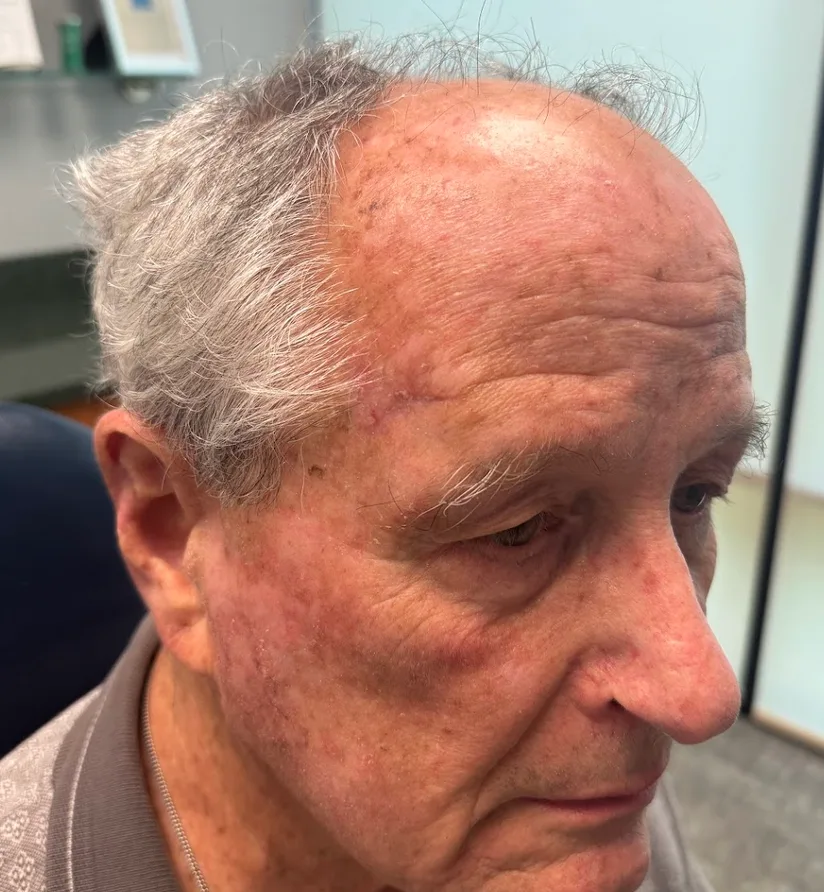 Mohs Surgery Before & After Patient #4660