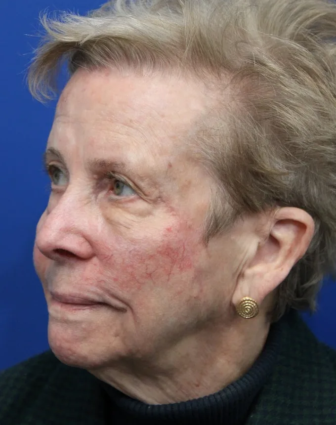 Mohs Surgery Before & After Patient #4661