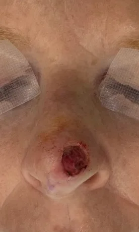 Mohs Surgery Before & After Patient #4662