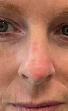 Mohs Surgery Before & After Patient #4662