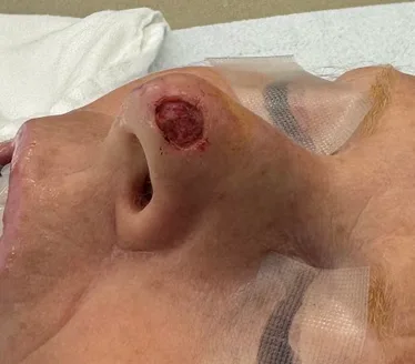 Mohs Surgery Before & After Patient #4662