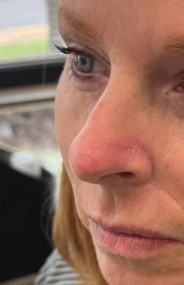Mohs Surgery Before & After Patient #4662