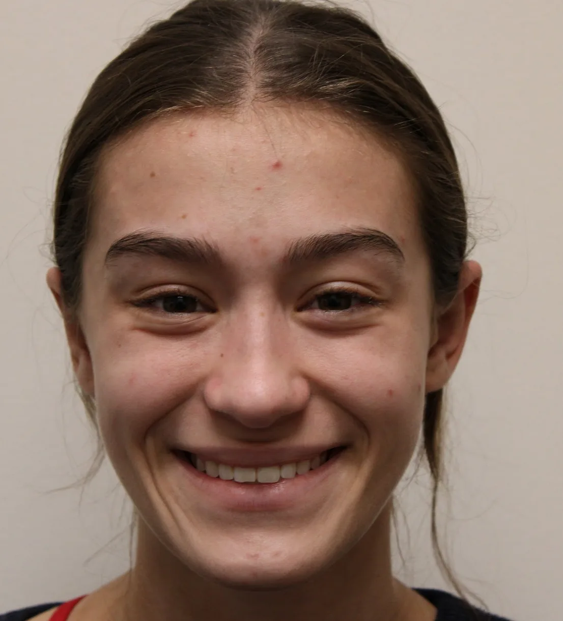 Otoplasty Before & After Patient #4664