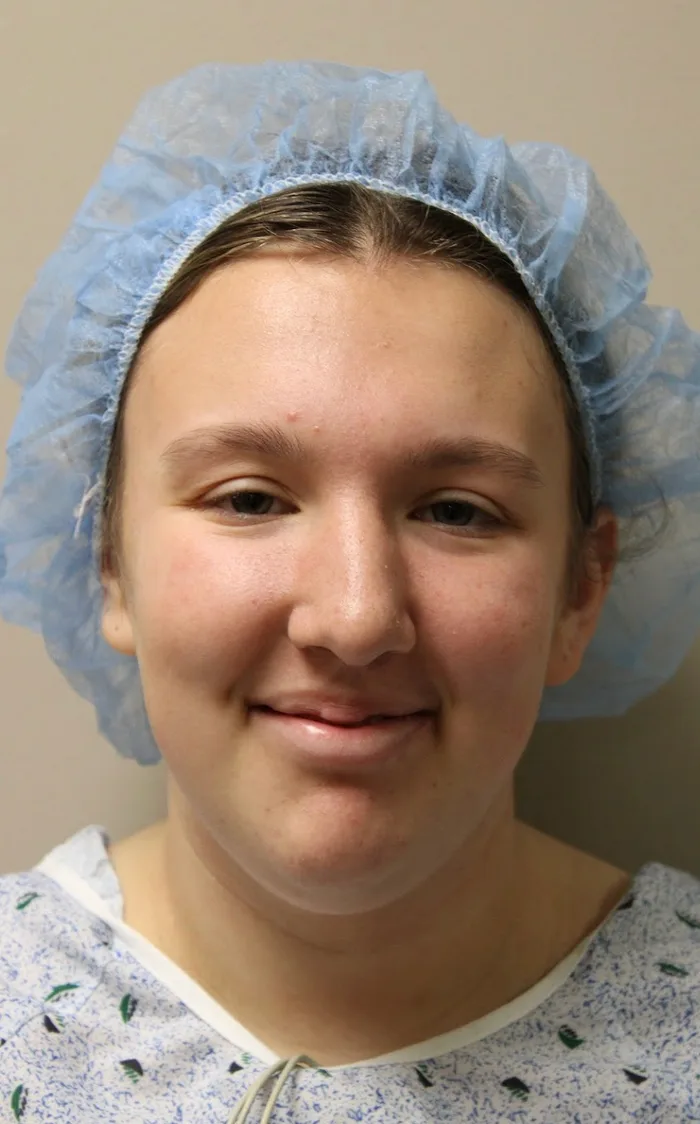 Rhinoplasty Before & After Patient #4666
