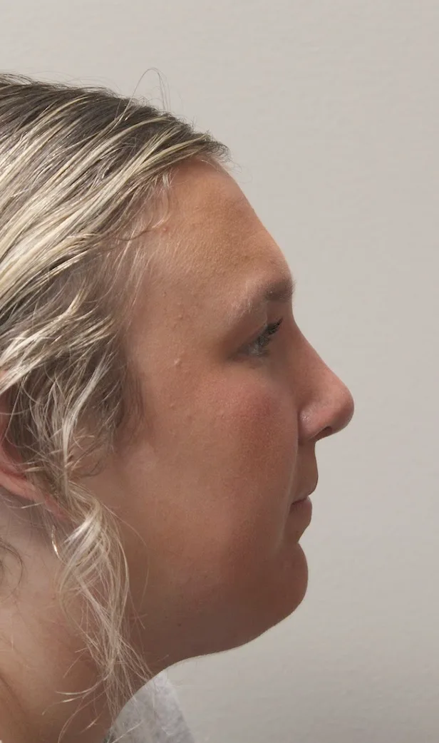 Rhinoplasty Before & After Patient #4666