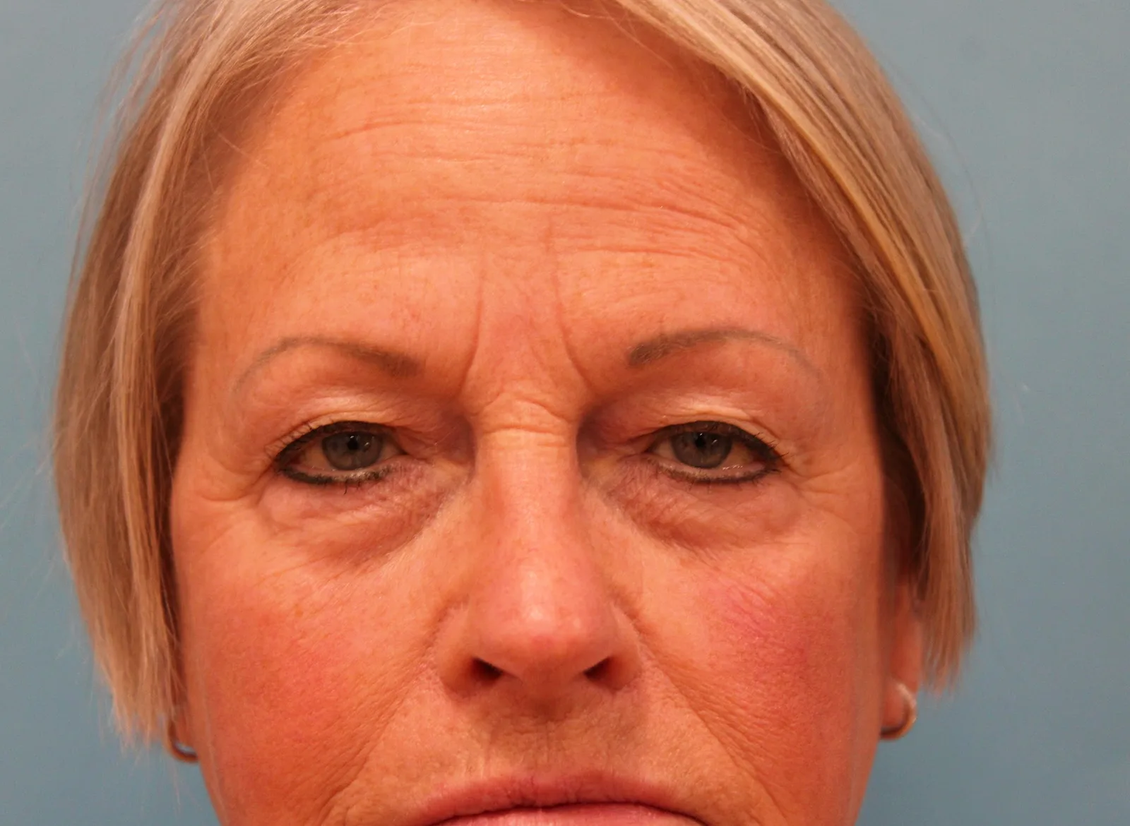 Upper Blepharoplasty Case 4667: before