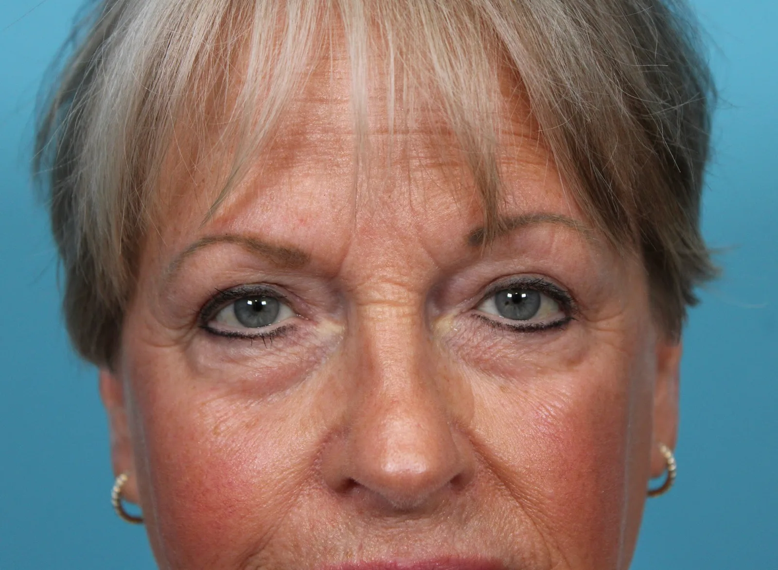 Upper Blepharoplasty Case 4667: after
