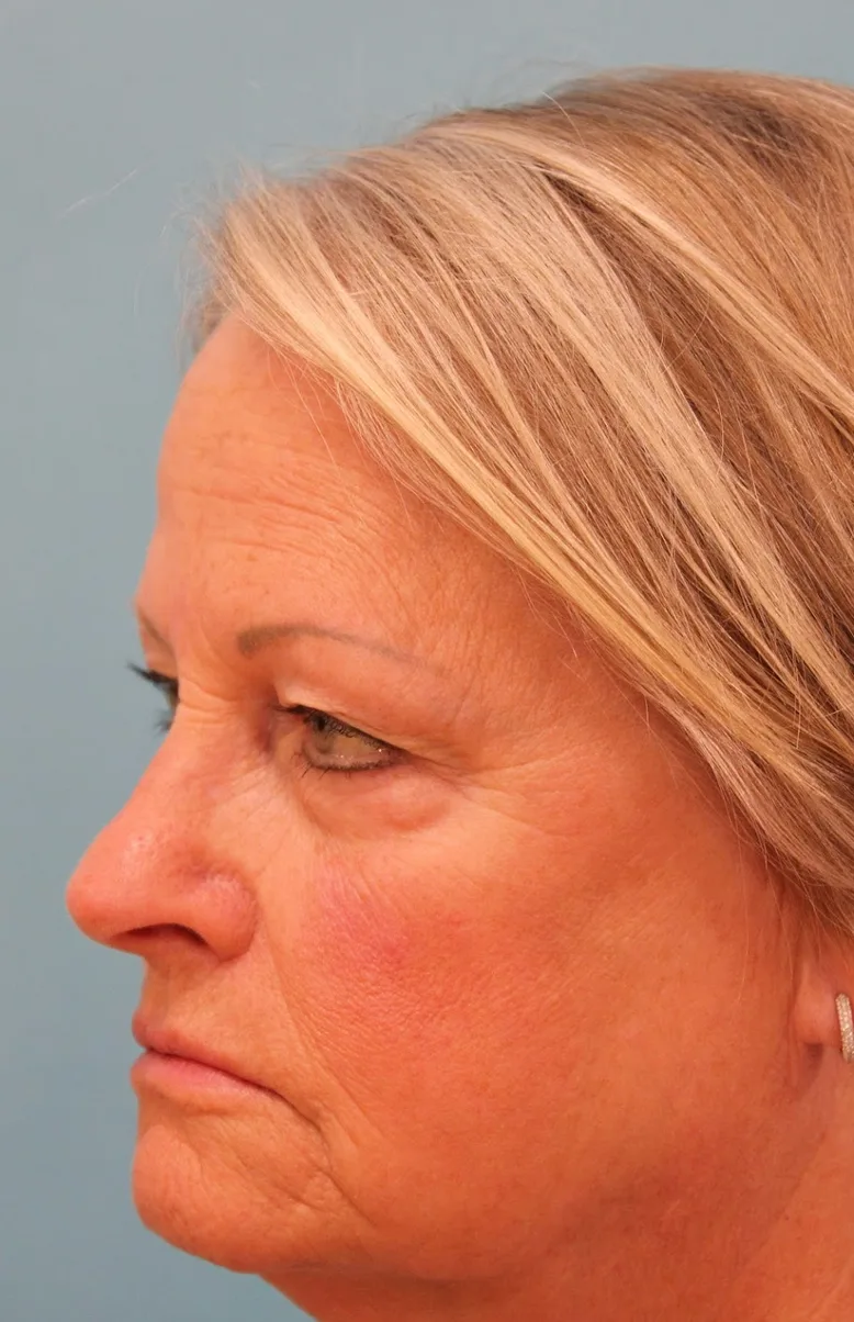 Upper Blepharoplasty Before & After Patient #4667