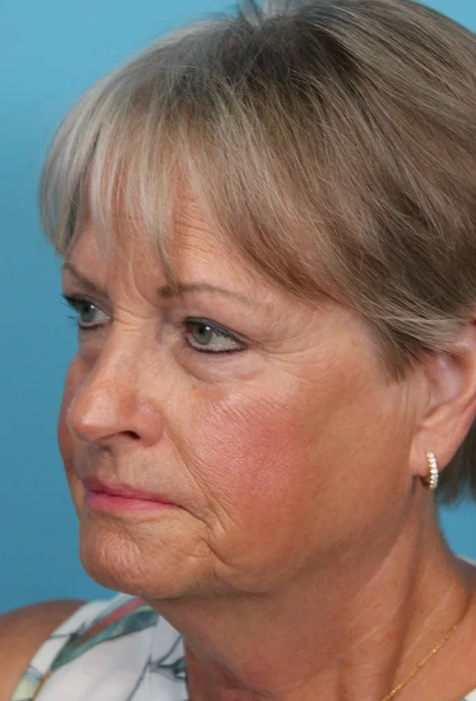 Upper Blepharoplasty Before & After Patient #4667