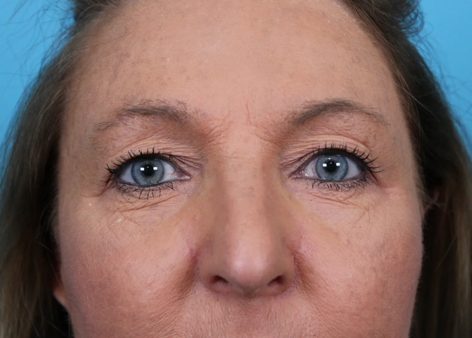 Upper Blepharoplasty Before & After Patient #4668