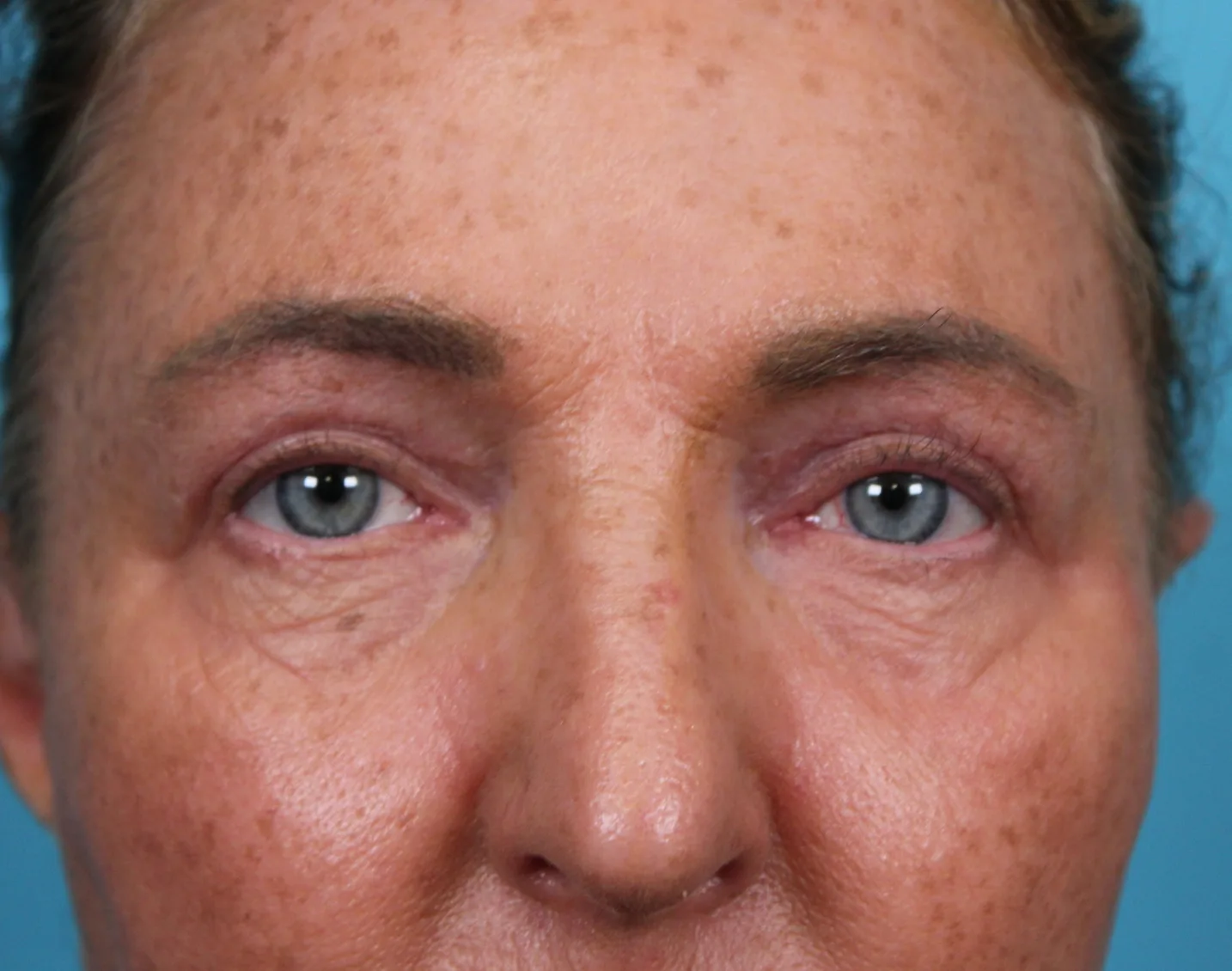 Upper Blepharoplasty Before & After Patient #4668