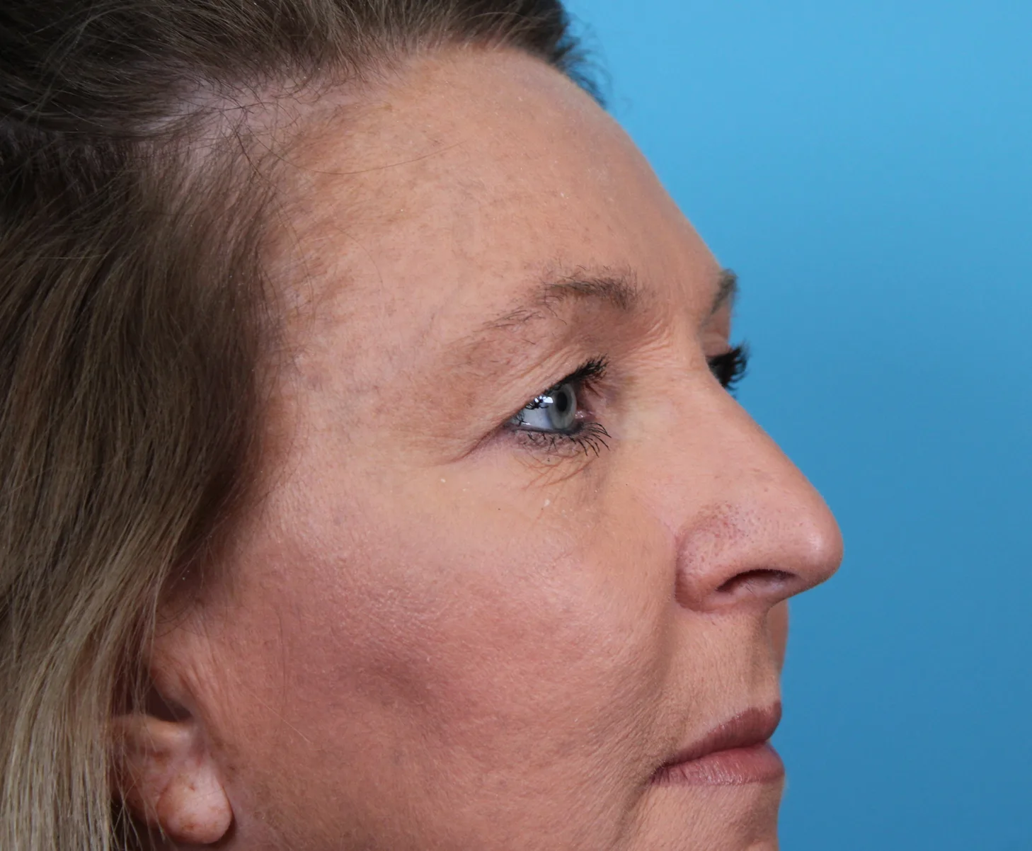 Upper Blepharoplasty Before & After Patient #4668