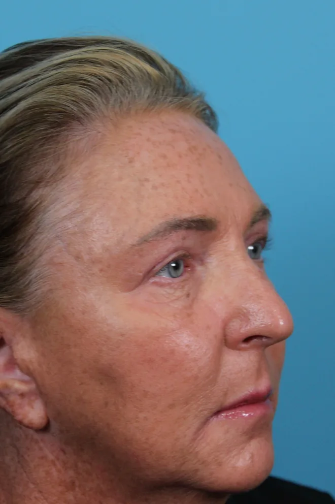 Upper Blepharoplasty Before & After Patient #4668