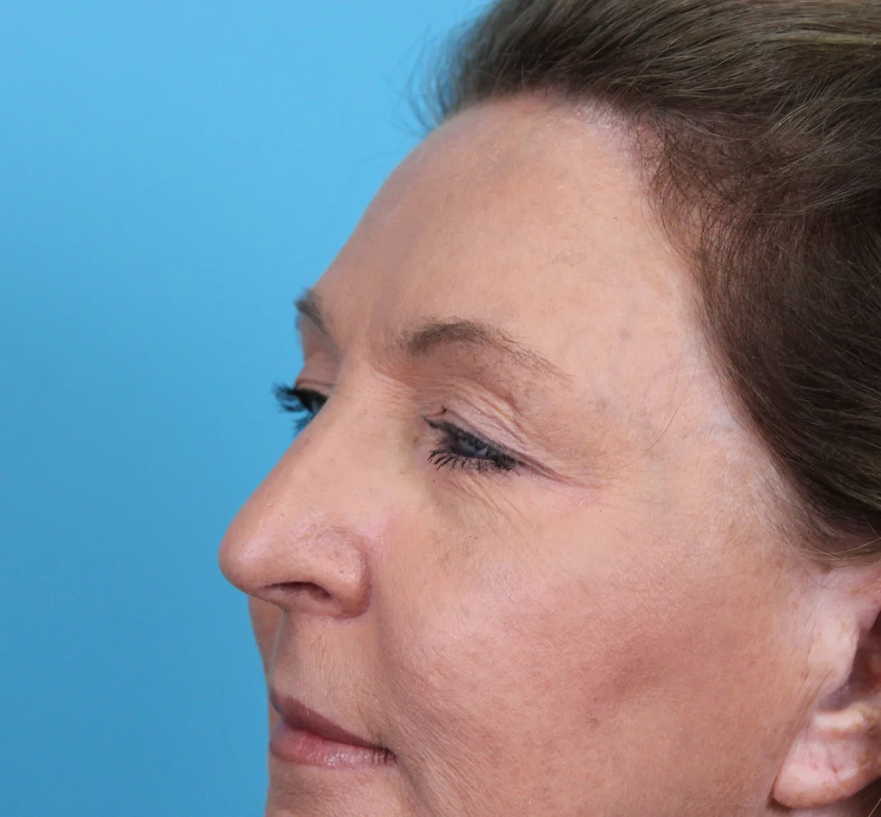 Upper Blepharoplasty Before & After Patient #4668