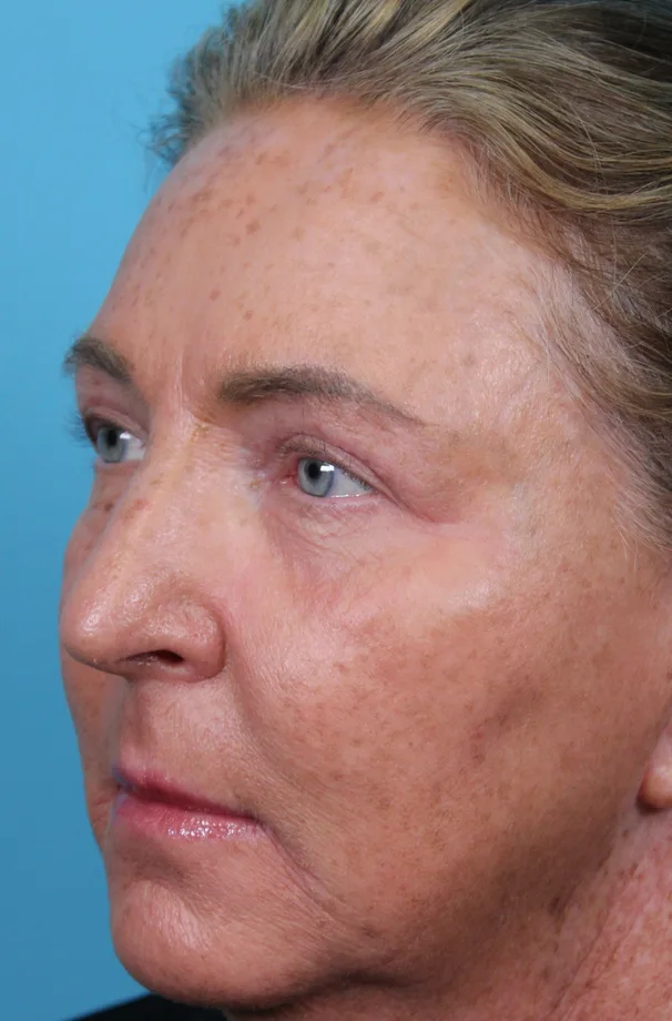 Upper Blepharoplasty Before & After Patient #4668