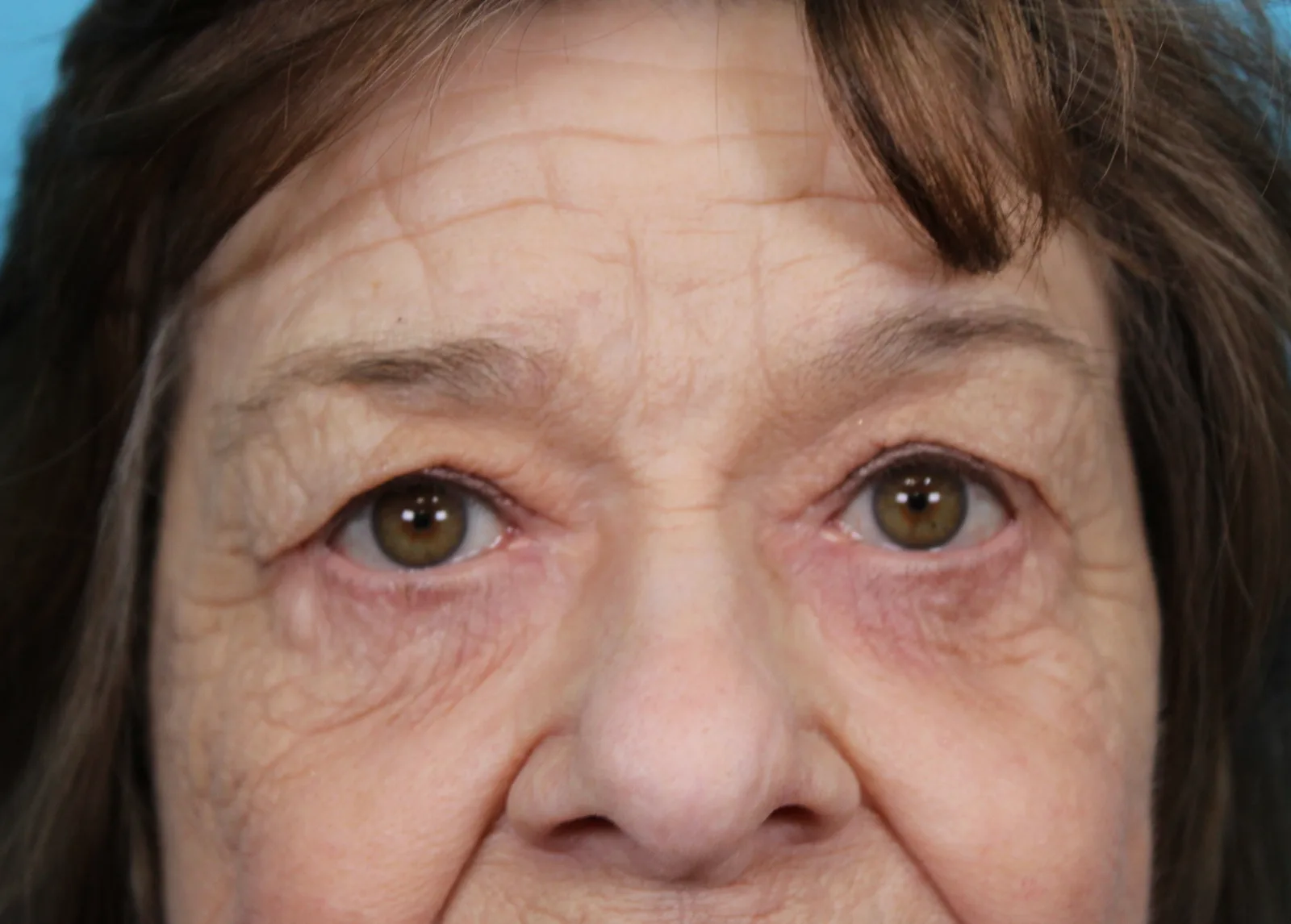 Upper Blepharoplasty Before & After Patient #4669