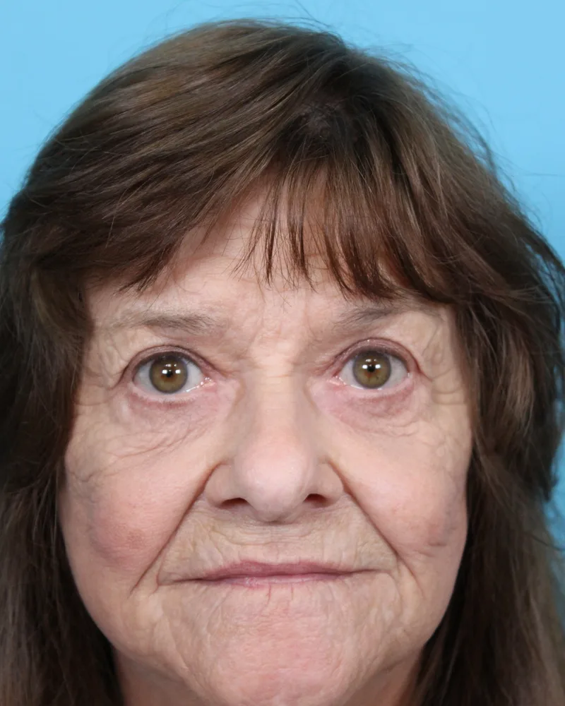 Upper Blepharoplasty Before & After Patient #4669