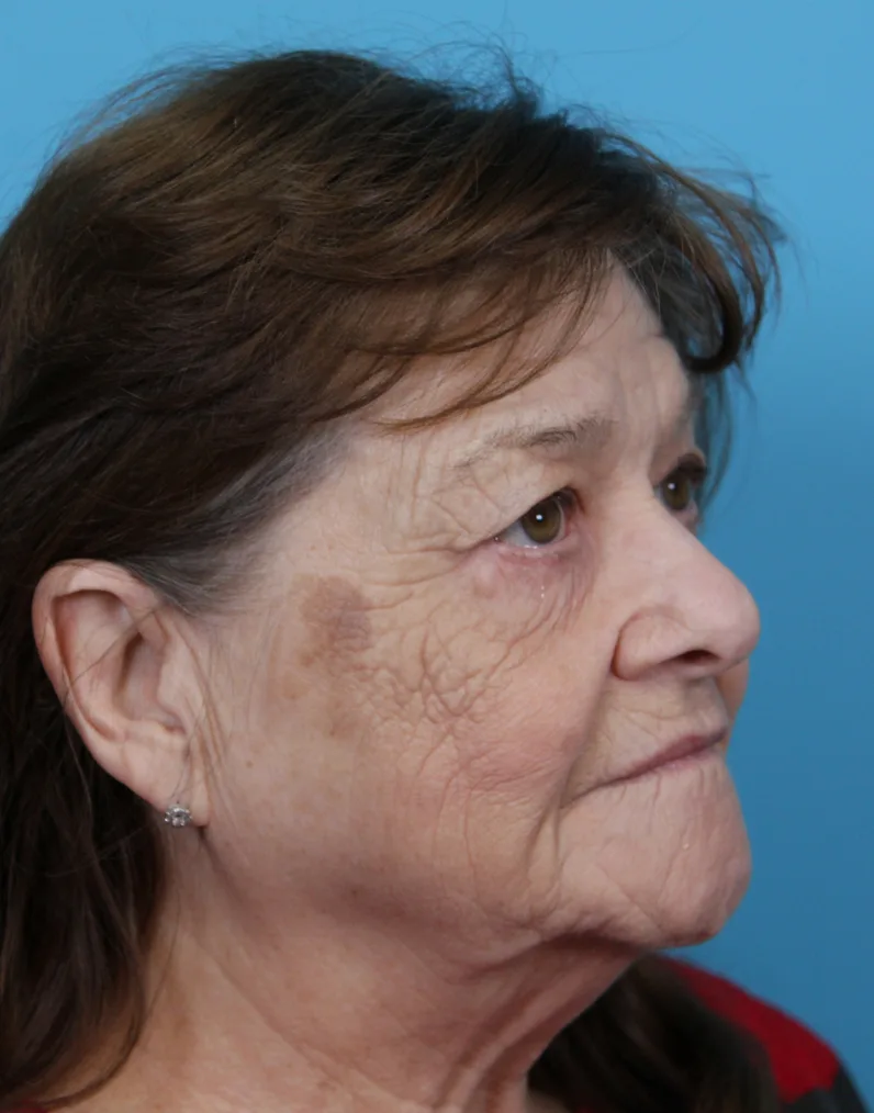Upper Blepharoplasty Before & After Patient #4669