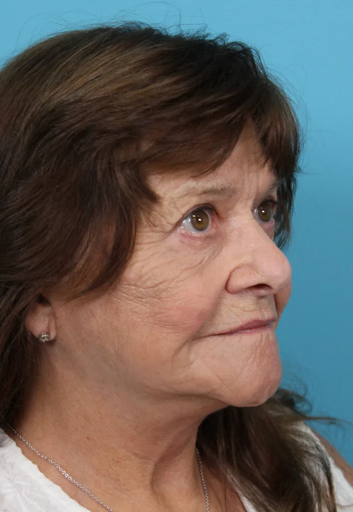Upper Blepharoplasty Before & After Patient #4669