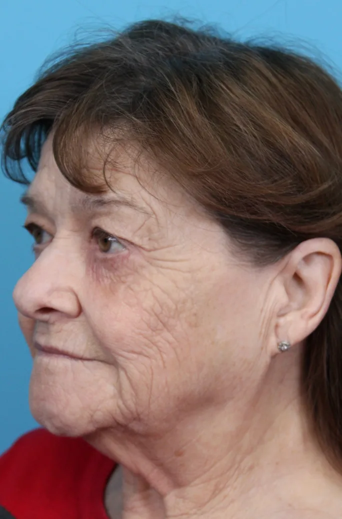 Upper Blepharoplasty Before & After Patient #4669