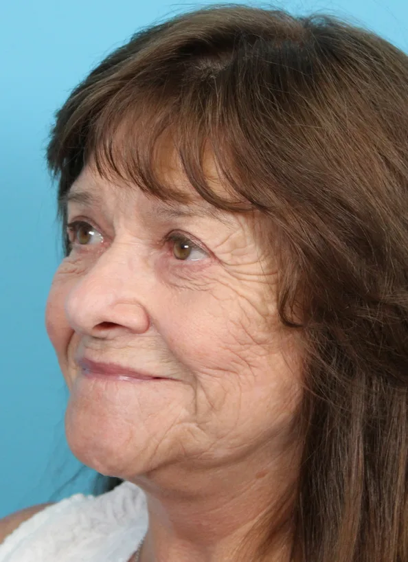 Upper Blepharoplasty Before & After Patient #4669