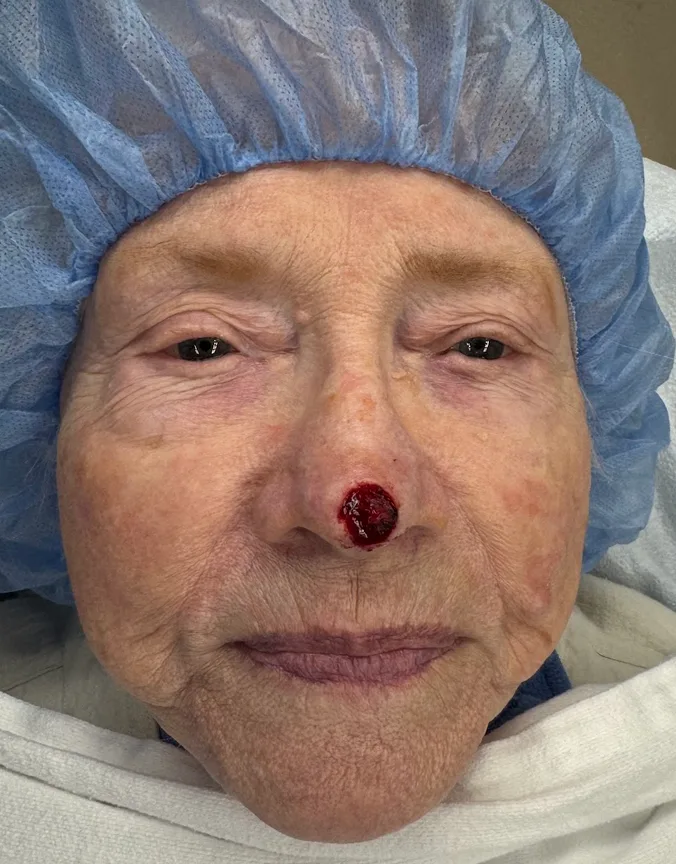 Mohs Surgery Before & After Patient #4786