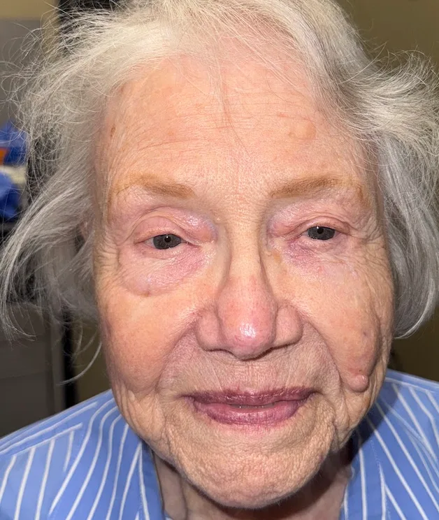 Mohs Surgery Before & After Patient #4786