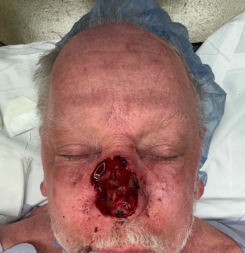 Mohs Surgery Before & After Patient #4826