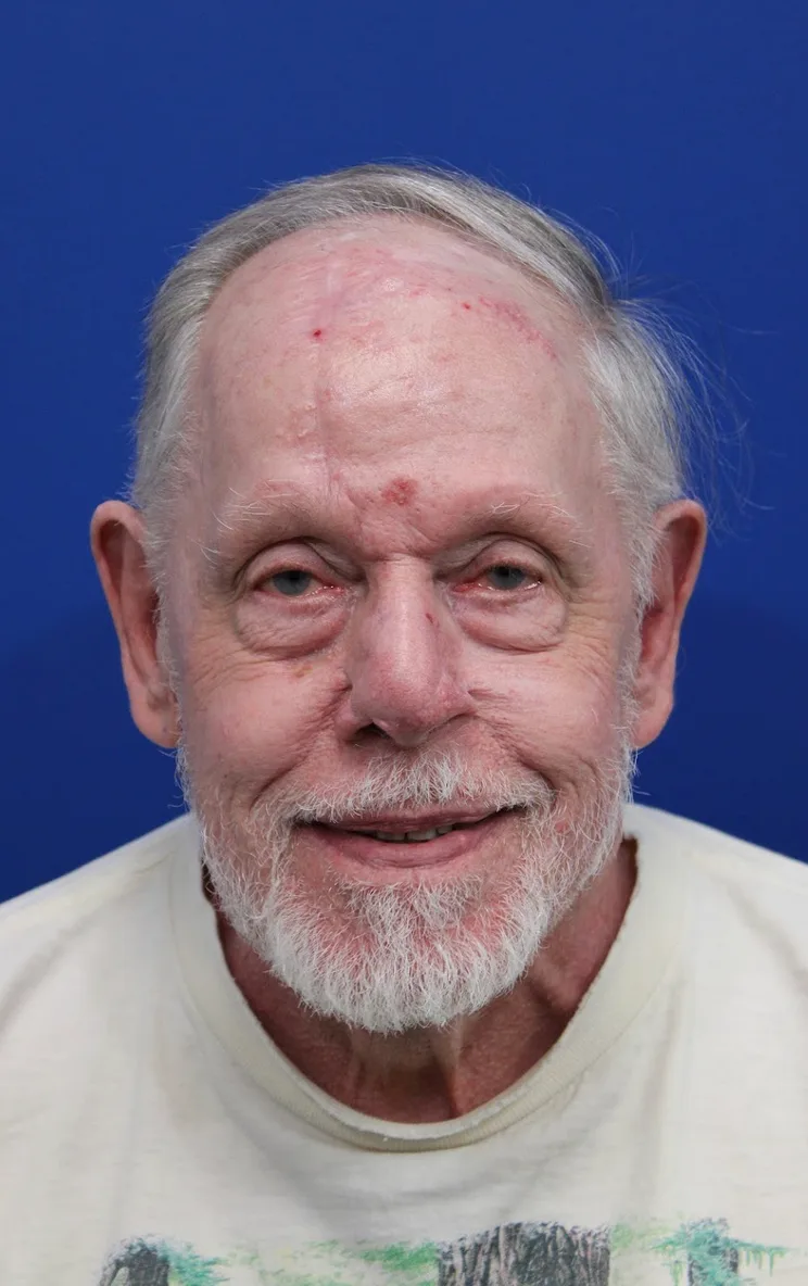 Mohs Surgery Before & After Patient #4826