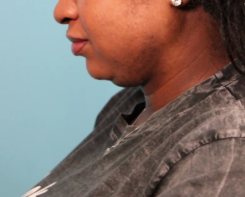 Submental Liposuction Before & After Patient #4789