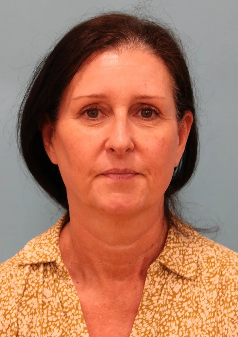 Facelift Before & After Patient #4957