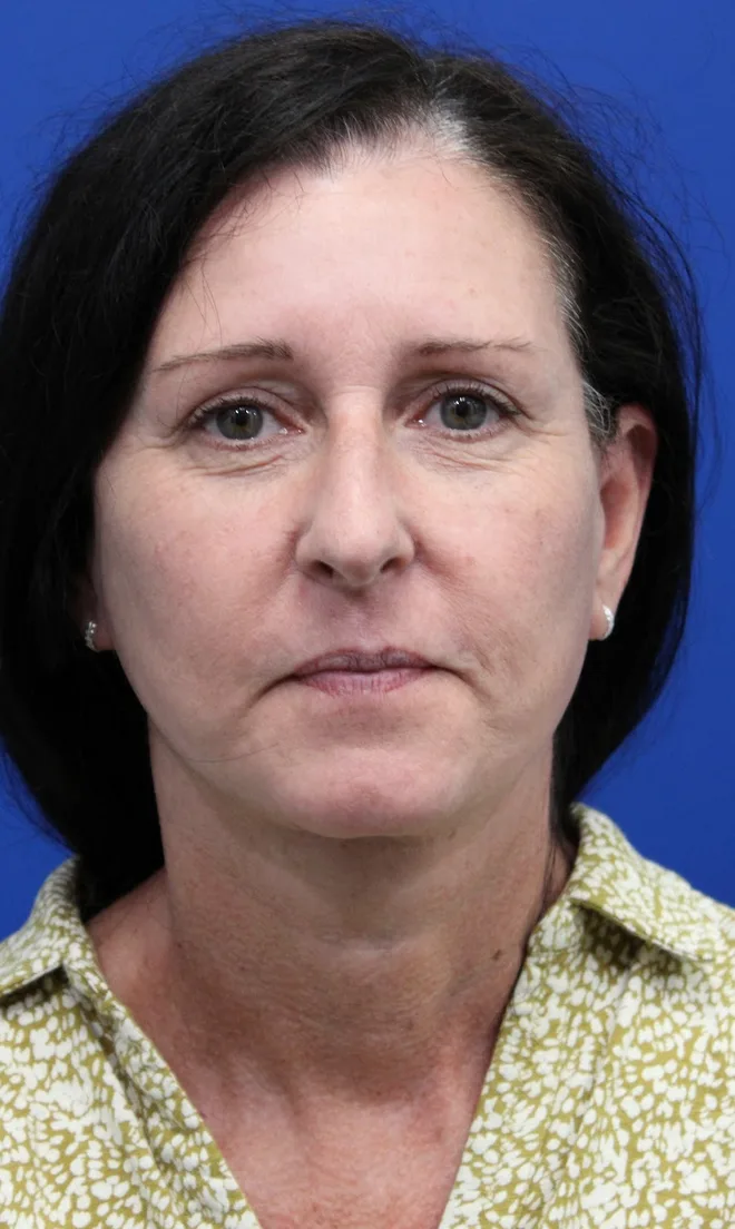 Facelift Before & After Patient #4957