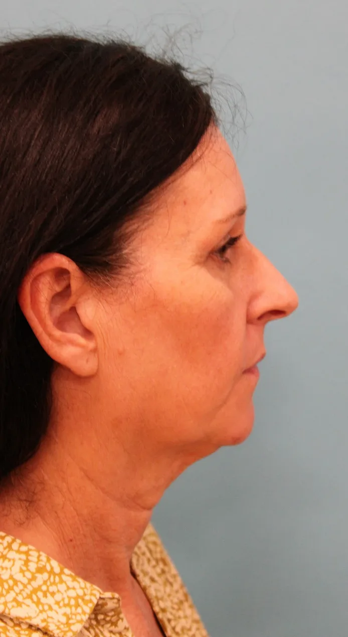 Facelift Before & After Patient #4957