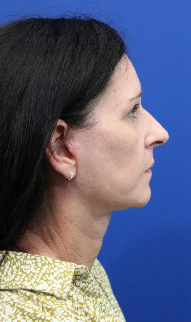 Facelift Before & After Patient #4957
