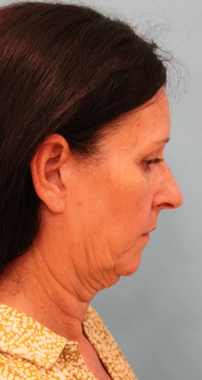 Facelift Before & After Patient #4957